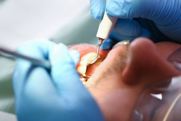Best Emergency Root Canal Treatment in Sebastopol, CA