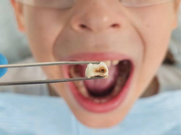 Best Pediatric Emergency Dentist in Sebastopol, CA